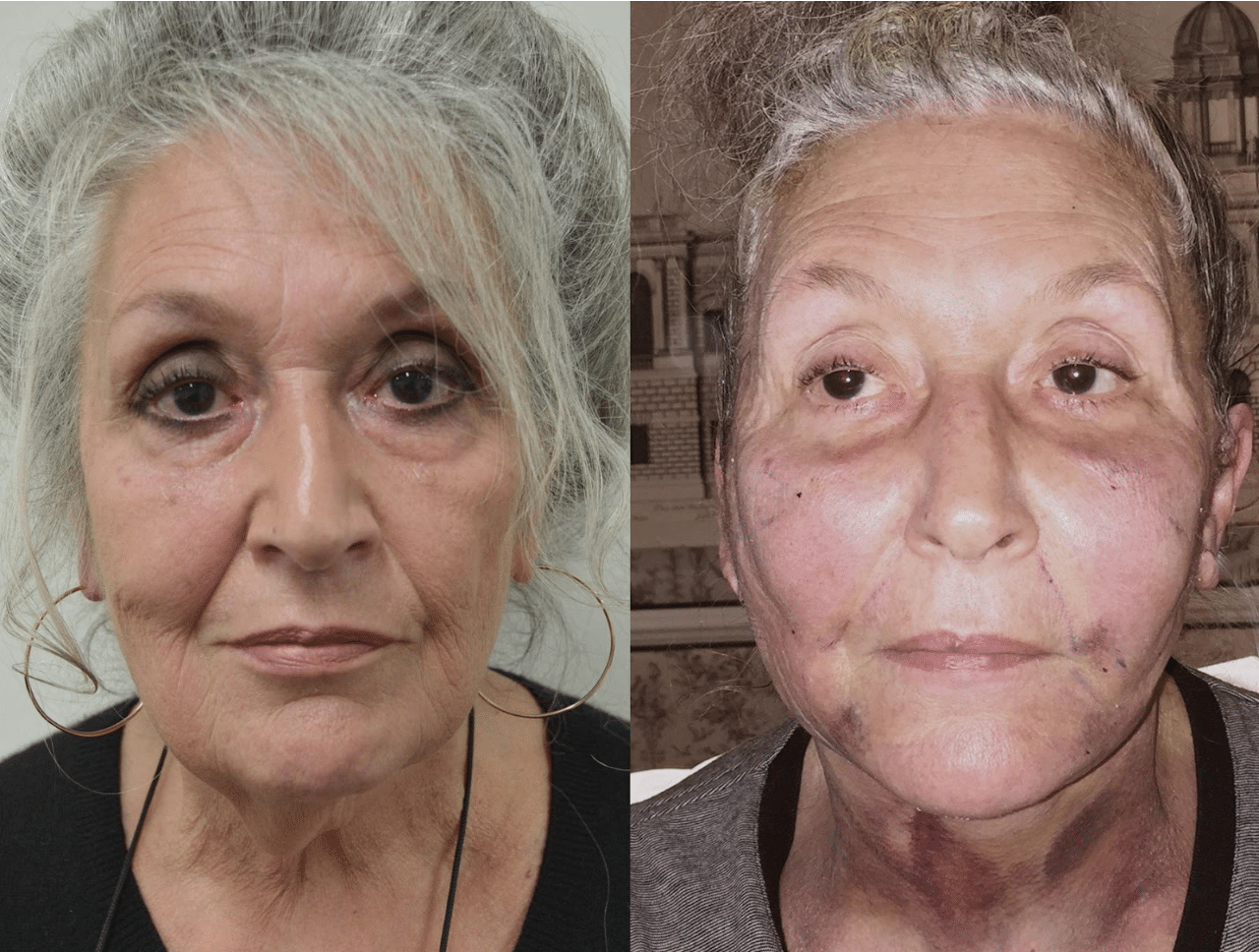 Facelift Case Study 1