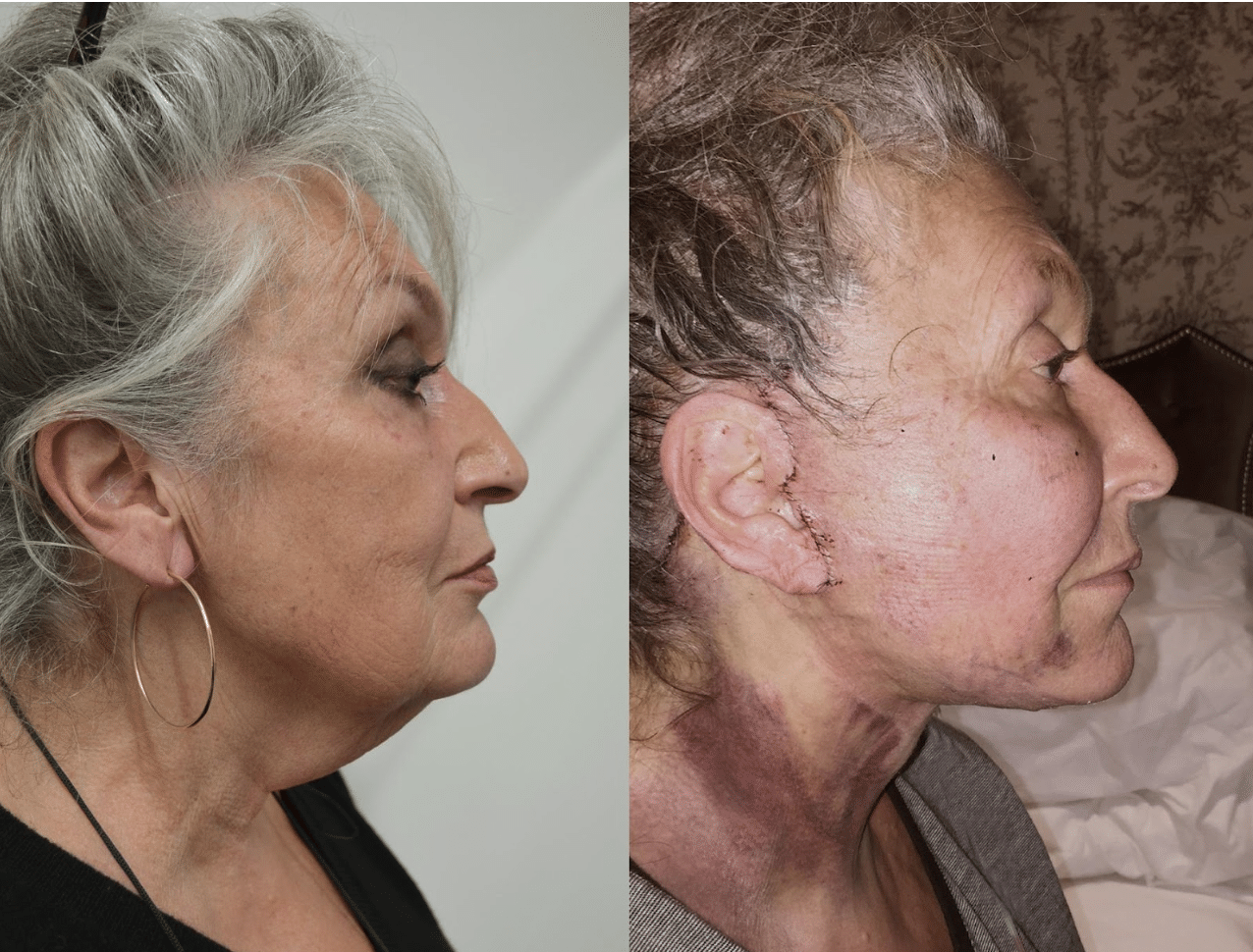 Facelift Case Study 2