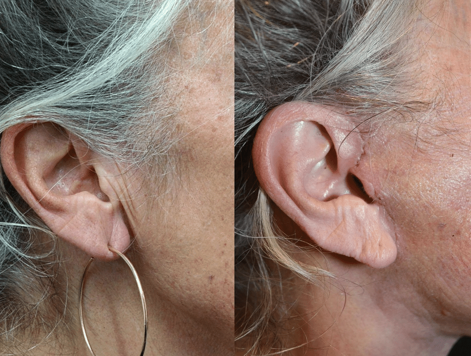 Facelift Scars